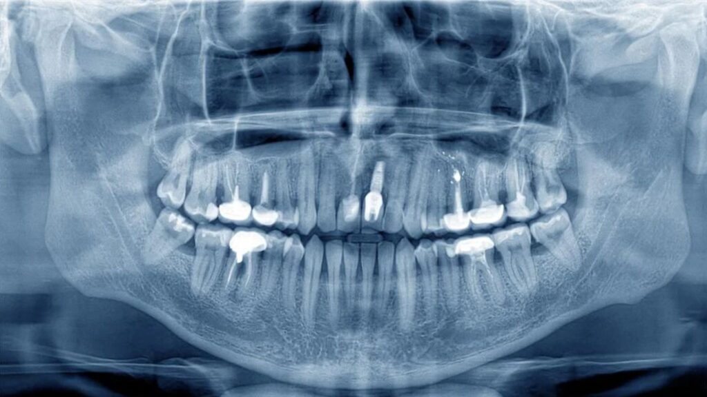 Artigo: Acidente aéreo e sua relação com a Odontologia – importância da arcada dentária na identificação de corpos